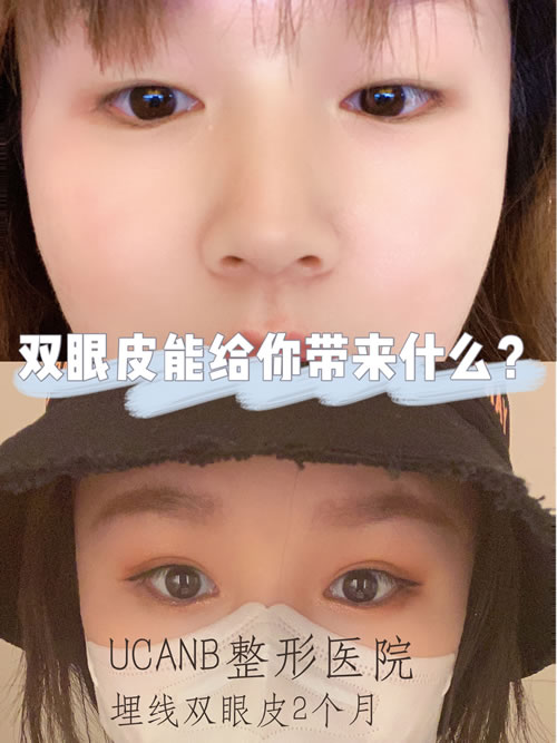 韩国UcanB整形外科埋线双眼皮案例