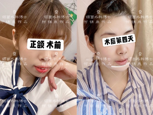 广州广大正颌手术日记分享,何锦泉地包天正颌手术日记合辑!