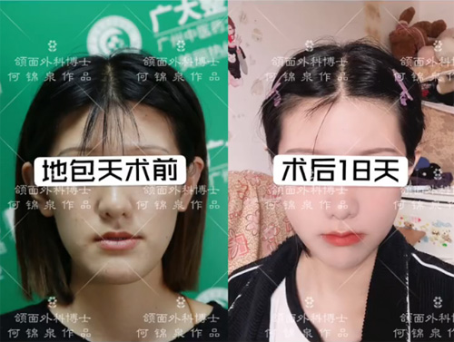 广州广大正颌手术日记分享,何锦泉地包天正颌手术日记合辑!