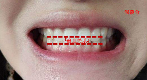 深覆合其实就是上前牙的牙冠覆盖下前牙牙冠的1/3或2/3,医生会把此类