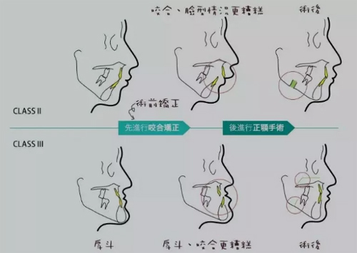 正颌骨手术千万别去做？揭秘正颌手术对人一辈子的影响！