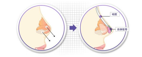 耳軟骨隆鼻優(yōu)勢(shì)分析
