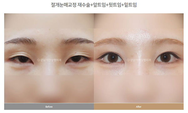 眼综合和双眼皮的区别