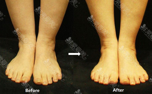 韩国JS美医院脚踝吸脂对比图