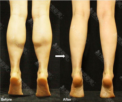 韩国JS美医院小腿整形手术病例图片