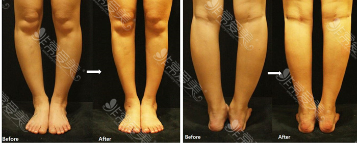  韩国JS美医院小腿+脚踝吸脂手术前后图片