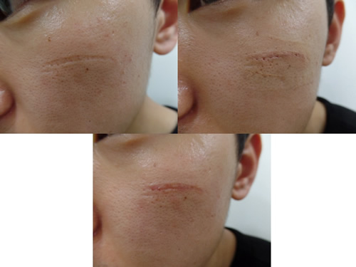 韩国陈整形外科去除面部凹陷疤痕展示