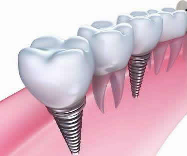 北京维恩口腔种植牙介绍