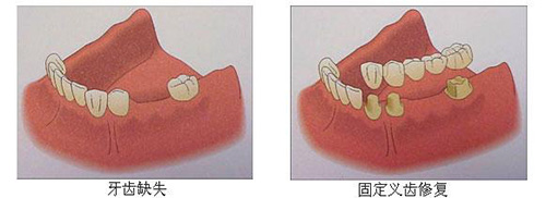 固定义齿修复牙齿缺失方式