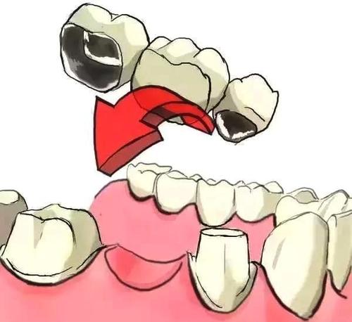 固定义齿修复牙齿缺失