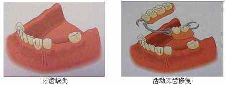 活动义齿修复牙齿缺失