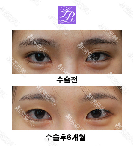 韩国laree整形医院双眼皮变单眼皮手术图片