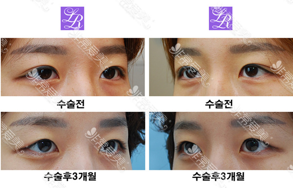 韩国laree整形外科双眼皮改单成功案例