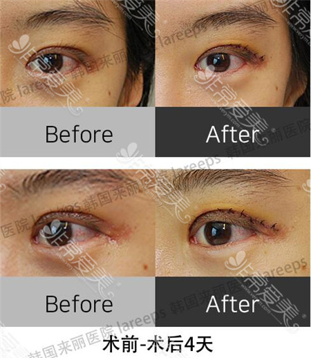 韩国laree整形医院割双眼皮术后4天效果图