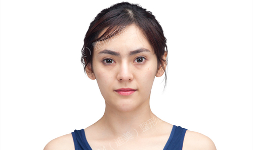 韩国迪美面部整形案例分享，记录泰国模特轮廓三件套过程
