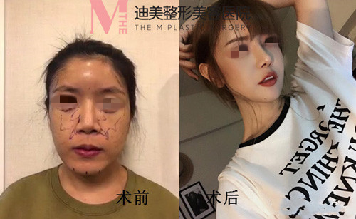 韩国迪美THE-M面部轮廓手术前后对比