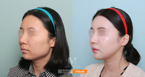 韩国迪美THE-M特色面部轮廓手术，为您塑造精致童颜少女脸！