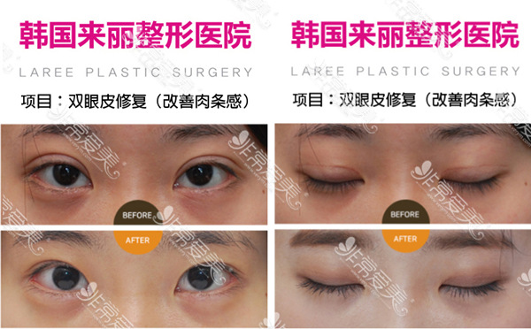 韩国来丽laree整形医院肉条双眼皮修复前后对比图片