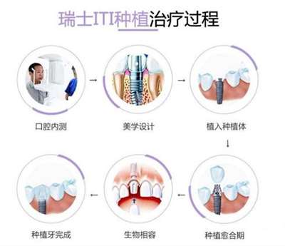 瑞士ITI種植系統(tǒng)種植過(guò)程