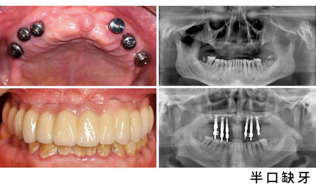 昆明美奥口腔半口种植牙案例