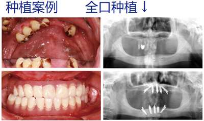 昆明美奧口腔種植牙案例