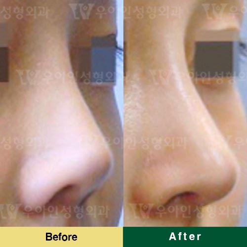 韩国优雅人整形外科鼻修复效果展示