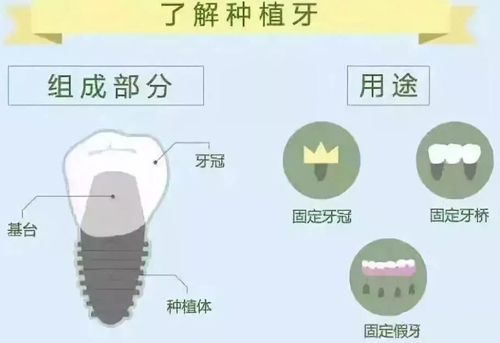种植牙组成结构及其用途