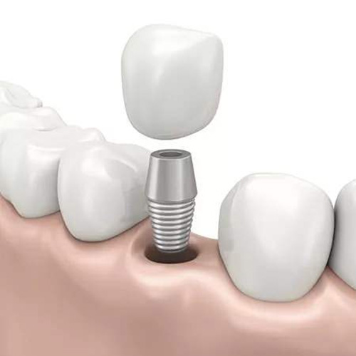 5000的种植牙能使用多久