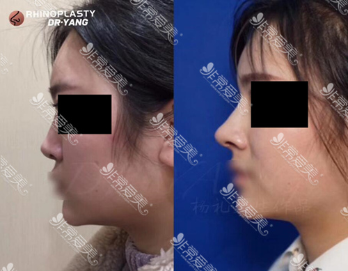 杨礼医生歪鼻鼻翼基底凹陷修复对比图