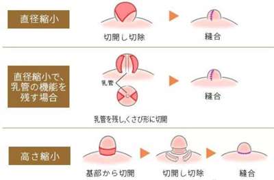 乳头缩小手术过程