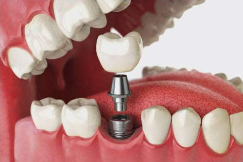 种植牙手术植入过程