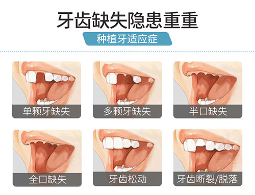 北京哪个医院做种植牙手术好？6000左右价格的有吗？