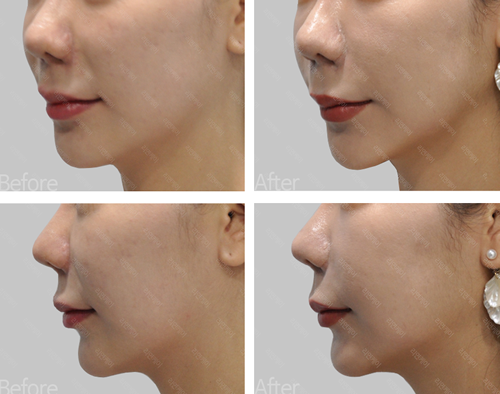 韩国丽妍K整形皮肤面部提升案例对比