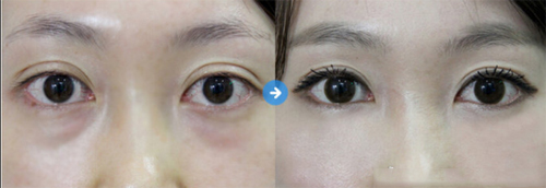 西京医院双眼皮手术