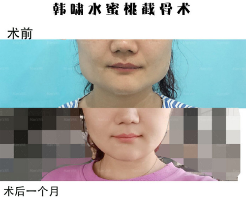 济南韩氏整形医院下颌角整形 济南韩氏整形医院下颌角整形