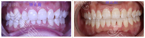 想做牙齿矫正听说杭州雅莱齿科不错,不知道有没有实例?