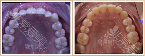 想做牙齿矫正听说杭州雅莱齿科不错,不知道有没有实例?