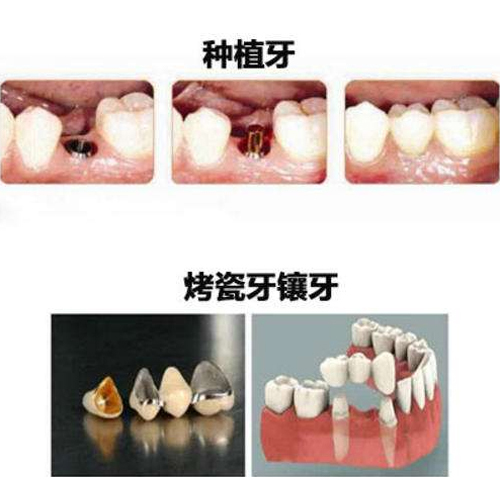 缺失牙的修复方式展示