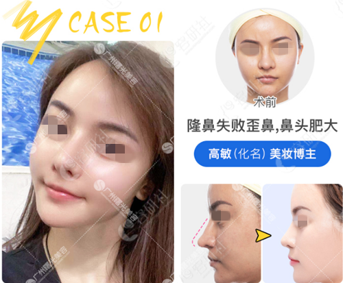 请看案例了解广州曙光王旭明和珠儿丽尹容逸隆鼻技术差异