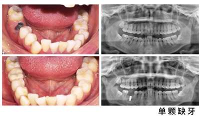 昆明美奥口腔医院单颗种植牙案例