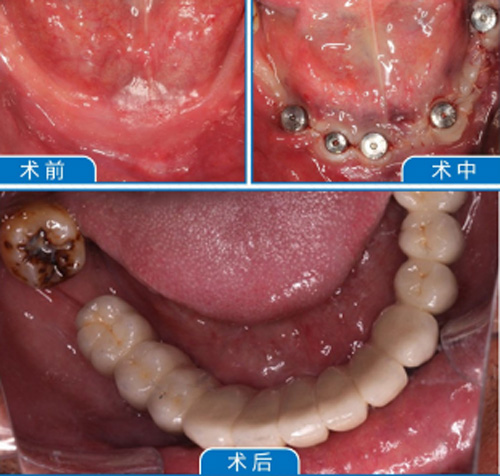 桂林藍(lán)天牙之美口腔種植牙