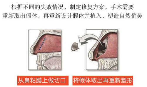 厦门鼻假体取出价格是多少 哪些正规整形医院可以做