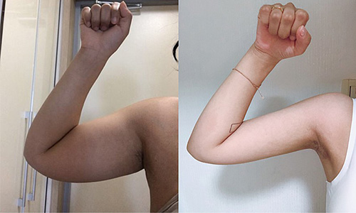 手臂和副乳吸脂前后对比