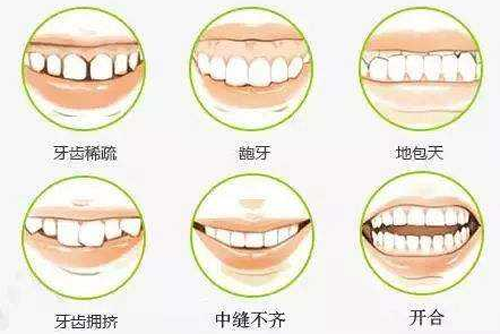 需要进行牙齿矫正类型