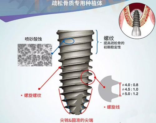 韩国奥齿泰种植牙质量怎么样？科普分析osstem种植体怎么样!