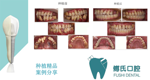 義烏傅氏口腔種植牙<span style=