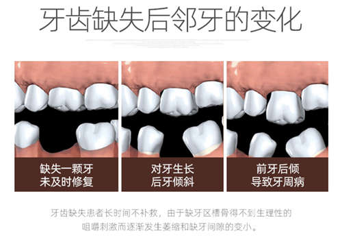 牙齿缺失牙齿变化