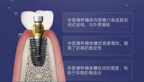 剖析：一颗5万种植牙和5千种植牙有何差别使用寿命呢？