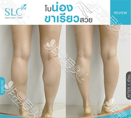 泰国slc整形医院瘦小腿