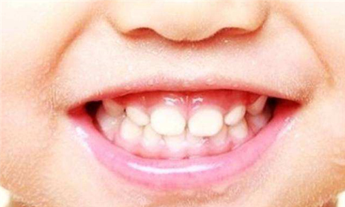 健康的儿童牙齿
